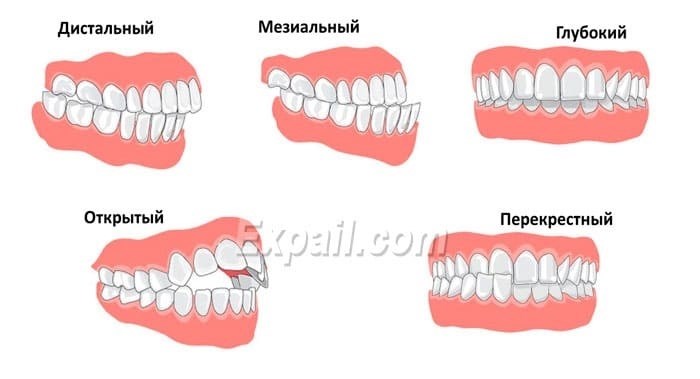 Неправильный прикус и армия: моя статистика